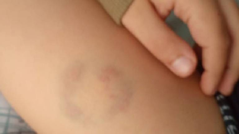 Καταγγελία: Διευθύντρια ειδικού σχολείου στην Άρτα δάγκωσε στο πόδι 11χρονο μαθητή ΑμεΑ!