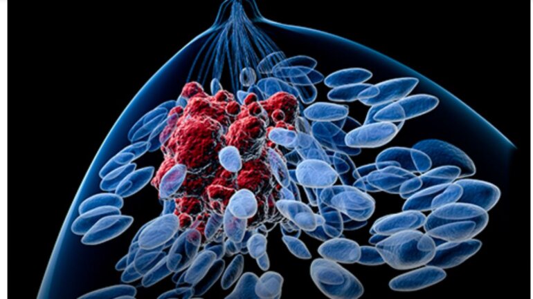 Πώς μια διατροφή υψηλής περιεκτικότητας σε λιπαρά συνδέεται με ανάπτυξη του καρκίνου