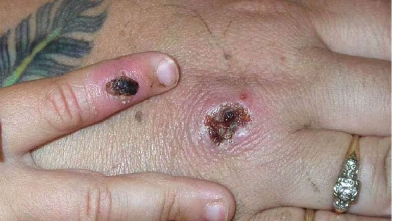 Όλα όσα πρέπει να ξέρετε για την ευλογιά των πιθήκων