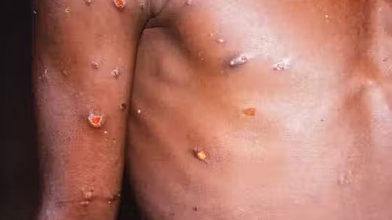 Καναδάς: Η επαρχία του Κεμπέκ επιβεβαίωσε 15 περιστατικά μόλυνσης από την ευλογιά των πιθήκων