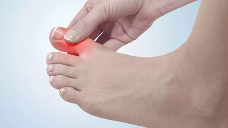 Ουρική αρθρίτιδα: Τι είναι και ποια τα συμπτώματα