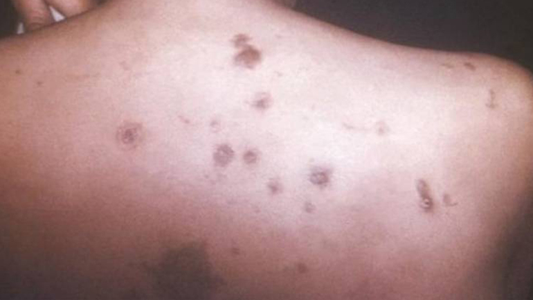 Συναγερμός σε ίδρυμα της Πάτρας: 16χρονη τρόφιμος διαγνώστηκε με σύφιλη