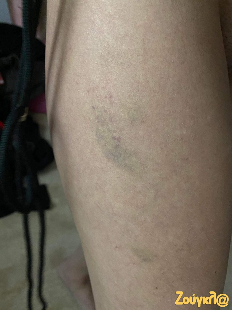 Η Γεωργία φωτογράφισε η ίδια τους μώλωπες που έχει στο σώμα της από το βράδυ της Πρωτοχρονιάς