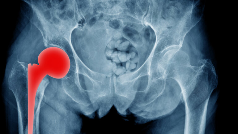 SuperPATH: Αποτελεσματική τεχνική για ολική αρθροπλαστική ισχίου