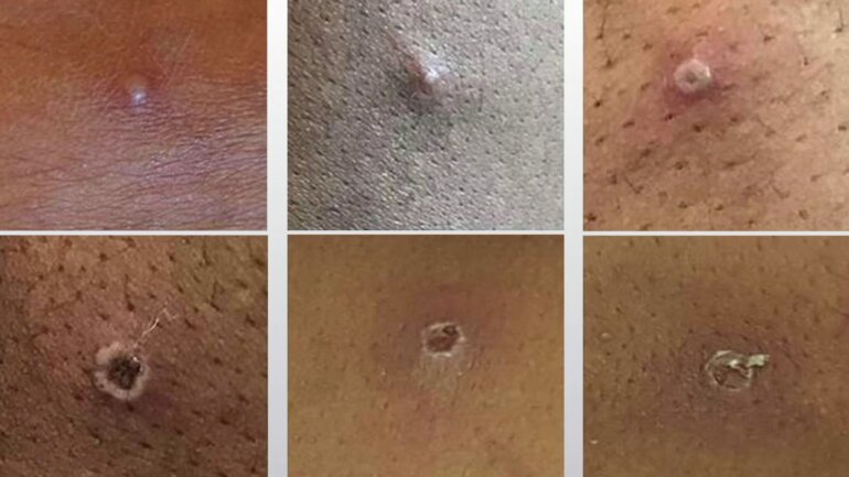 Παγκόσμιος Οργανισμός Υγείας: Η ευλογιά των πιθήκων συνιστά «πραγματικό» κίνδυνο