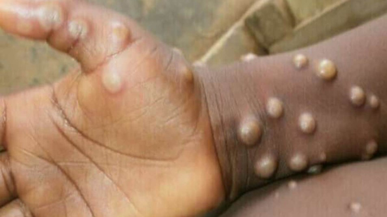 ΕΟΔΥ: Επιβεβαιώθηκε το πρώτο κρούσμα ευλογιάς των πιθήκων στην Ελλάδα