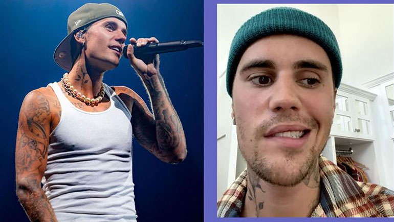 Justin Bieber: Παρέλυσε το πρόσωπό του από το σύνδρομο Ramsay Hunt – Το σοκαριστικό βίντεο