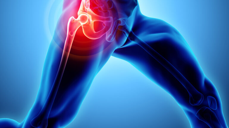 Τεχνική AMIS: Η πλέον φιλική προς τον ασθενή θεραπεία της οστεοαρθρίτιδας