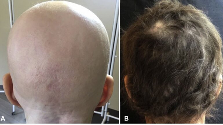 Ο FDA ενέκρινε φάρμακο κατά της αλωπεκίας – Εντυπωσιακά αποτελέσματα, λένε οι επιστήμονες