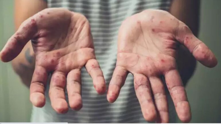 O ιός της ευλογιάς των πιθήκων έχει εξελιχθεί με απροσδόκητο ρυθμό – 50 νέες μεταλλάξεις