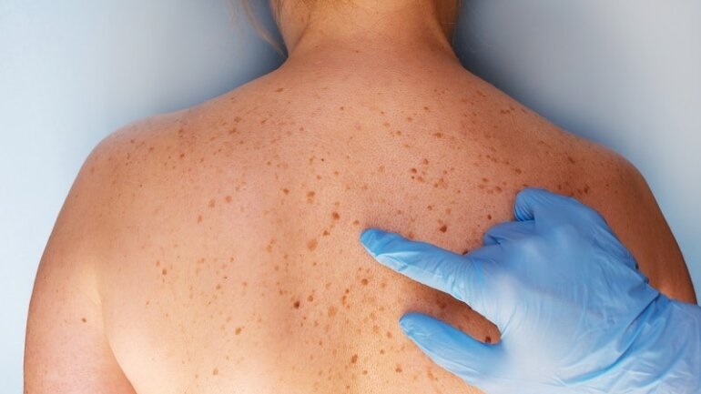 Οι τρεις βασικοί καρκίνοι του δέρματος