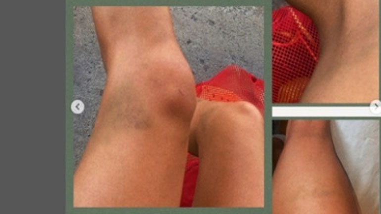 Κολύμβηση: Καναδή Ολυμπιονίκης κατήγγειλε ότι βρέθηκε ναρκωμένη με μώλωπες