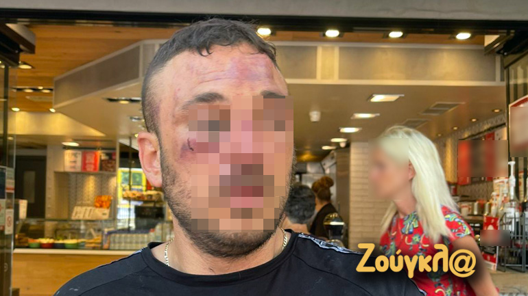 Ο τραυματίας πολίτης μετά τον ξυλοδαρμό του από τους αστυνομικούς