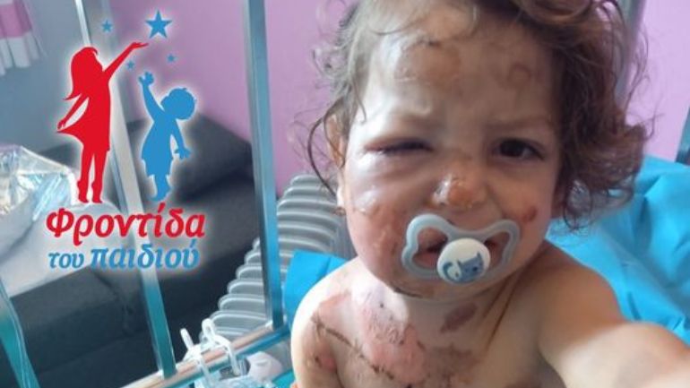 Έκκληση για βοήθεια στον μικρό Ιωσήφ που υπέστη σοβαρά εγκαύματα