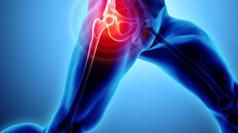 Πόνος στο ισχίο: Ένα συχνό, σύνηθες αλλά και ύπουλο σύμπτωμα