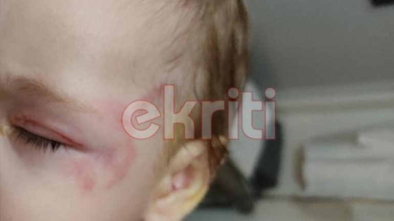 Ηράκλειο: Σκύλος επιτέθηκε σε γιαγιά και το εγγονάκι της