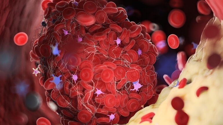 Κίνδυνος επαναλοίμωξης με το στέλεχος ΒΑ.5 μετά από νόσηση με προηγούμενα στελέχη του SARS-CoV-2