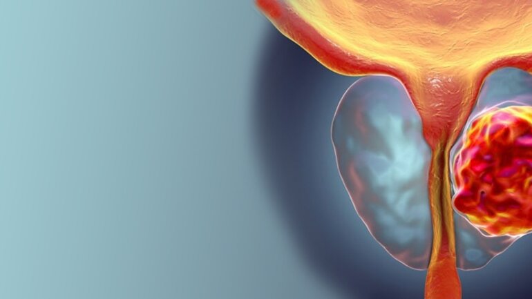 Επαναστατικές τεχνικές REZUM-HoLEP αντιμετώπισης προστάτη και laser λιθοτριψίας 