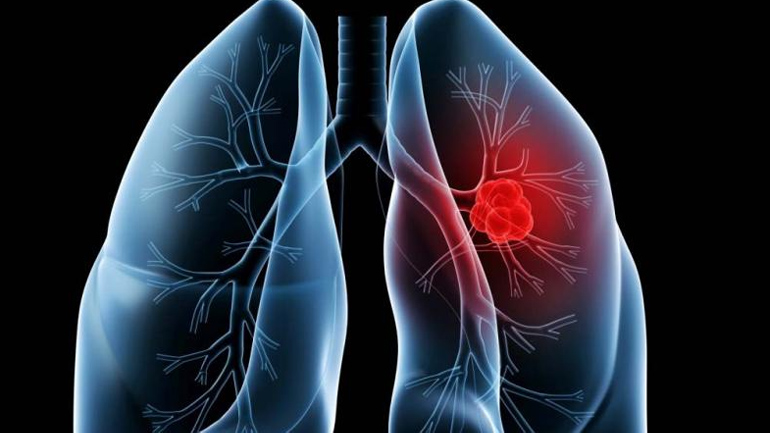 Η ανακάλυψη ότι η ατμοσφαιρική ρύπανση προκαλεί καρκίνο, θα ξαναγράψει τους κανόνες