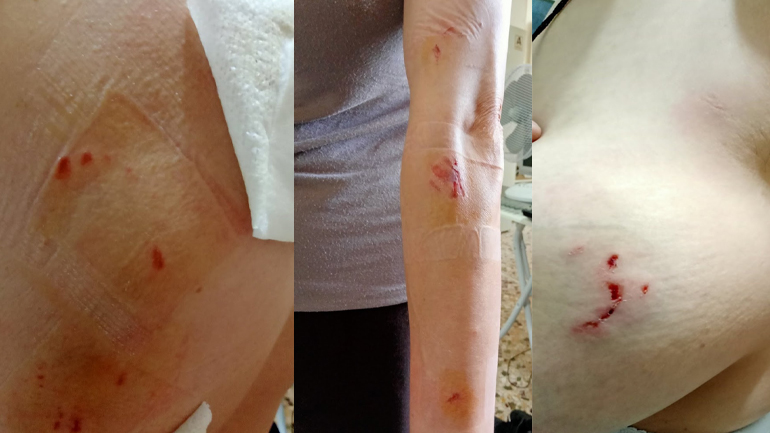 Καματερό: Γυναίκα δέχθηκε άγρια επίθεση από σκύλους