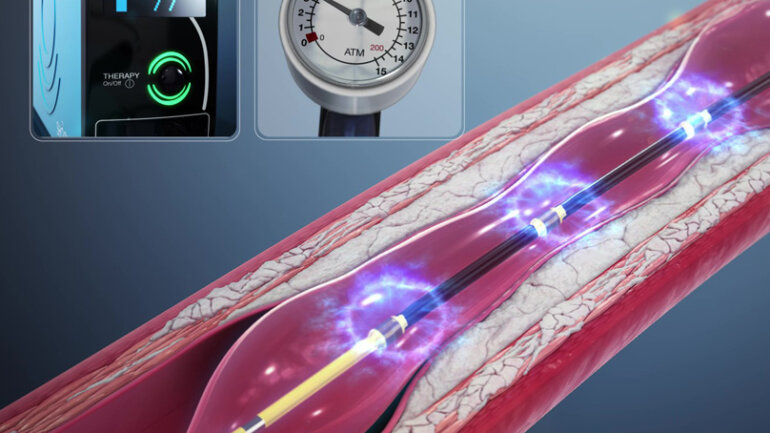 Ενδοστεφανιαία λιθοτριψία: Σύγχρονη αντιμετώπιση στεφανιαίων βλαβών