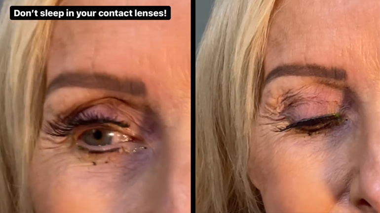 Oφθαλμίατρος αφαιρεί 23 φακούς επαφής από μια γυναίκα