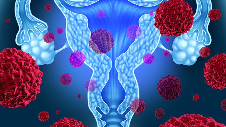 Καρκίνος του ενδομητρίου: Τα νεότερα δεδομένα για τη θεραπεία
