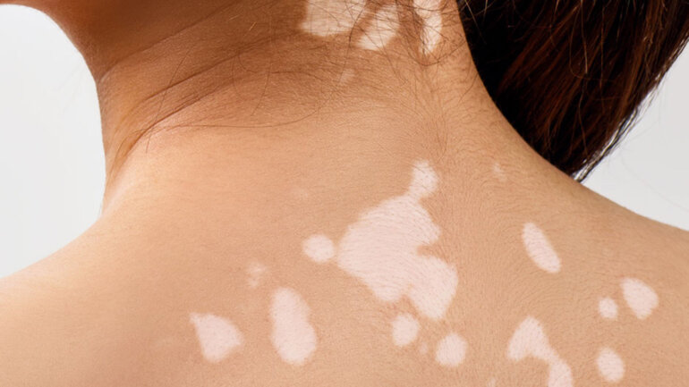 Τι είναι η λεύκη – Και ποια μικροθρεπτικά συστατικά θα μπορούσαν να βοηθήσουν Τι είναι η λεύκη – Και ποια μικροθρεπτικά συστατικά θα μπορούσαν να βοηθήσουν