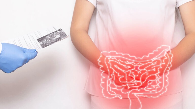 Τα φλεγμονώδη νοσήματα του εντέρου συνυπάρχουν συχνά με ρευματικά και μυοσκελετικά νοσήματα