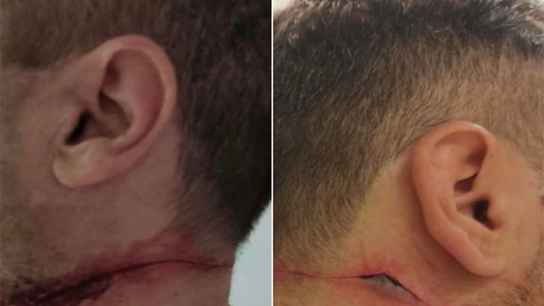 Θεσσαλονίκη: Αλλοδαπός επιτέθηκε σε αστυνομικούς και τους χαράκωσε στον λαιμό