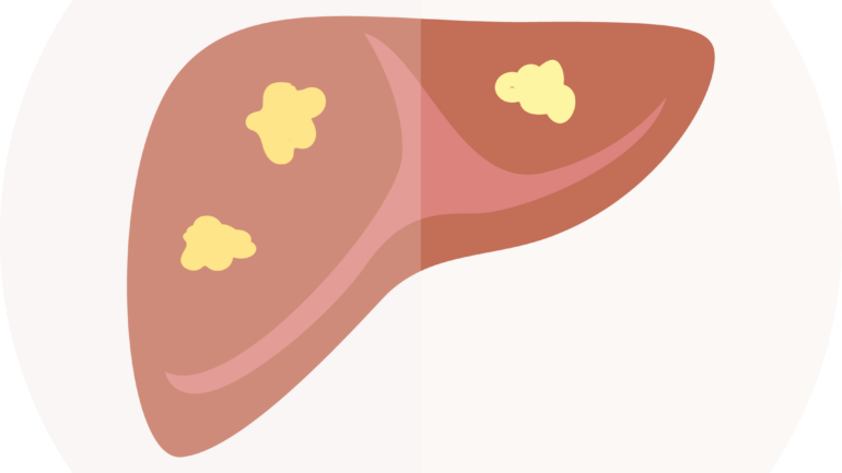 Μη αλκοολική λιπώδης νόσος του ήπατος: Μια σύγχρονη επιδημία;