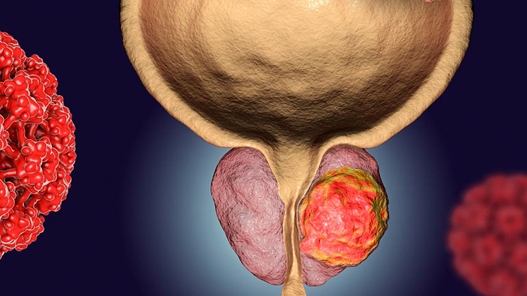 HοLEP – Rezum: οι πιο σύγχρονες τεχνικές για την καλοήθη υπερπλασία προστάτη