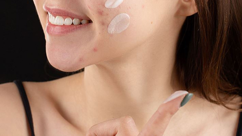 Σπυράκια στο πρόσωπο: Τα λάθη που κάνουμε