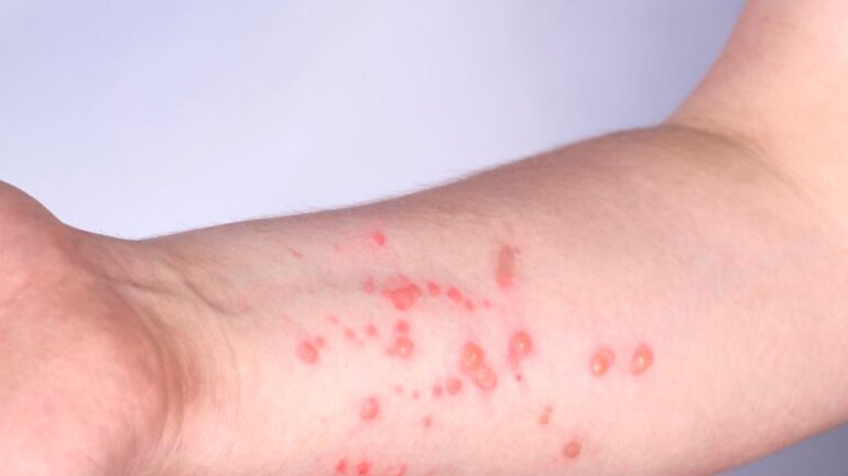 Η ευλογιά των πιθήκων μεταδίδεται έως τέσσερις μέρες πριν τα πρώτα συμπτώματα