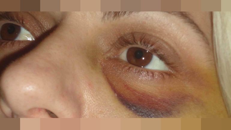 Υποψήφιος δήμαρχος που καταδικάστηκε τελεσίδικα για ξυλοδαρμό γυναίκας πήρε εκ νέου το χρίσμα από τη ΝΔ