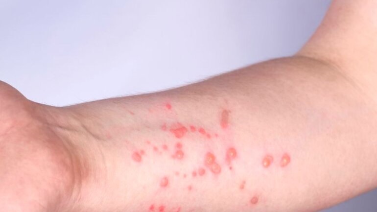 Ο Παγκόσμιος Οργανισμός Υγείας θα χρησιμοποιεί πλέον τον όρο «mpox» για την ευλογιά των πιθήκων