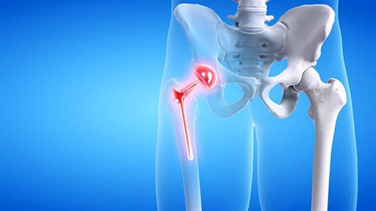 Η αύξηση της πρόσληψης πρωτεΐνης μπορεί να προφυλάξει από κάταγμα ισχίου