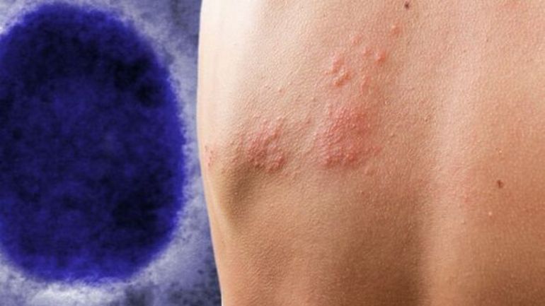 Ευλογιά π: Η κυβέρνηση των ΗΠΑ ετοιμάζεται να τερματίσει την κατάσταση υγειονομικής έκτακτης ανάγκης που είχε κηρύξει