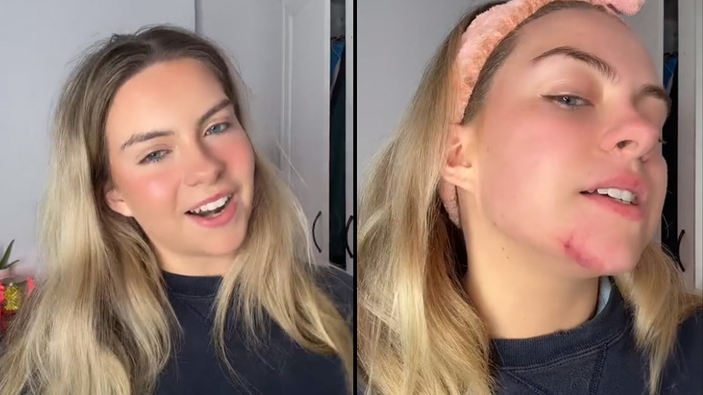 Μια Tiktoker μας δείχνει τη σπάνια δερματική της νόσο