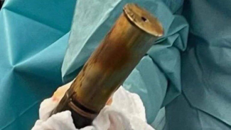 Εκκενώθηκε νοσοκομείο στη Γαλλία επειδή ένας άνδρας πήγε στα επείγοντα με οβίδα του Α’ Παγκοσμίου στον πρωκτό του