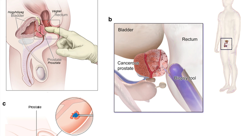 Δείκτες πρόγνωσης καλύτερης στυτικής λειτουργίας μετά την προστατεκτομή