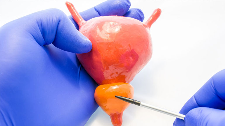 Μη επεμβατική αντιμετώπιση της καλοήθους υπερπλασίας του προστάτη