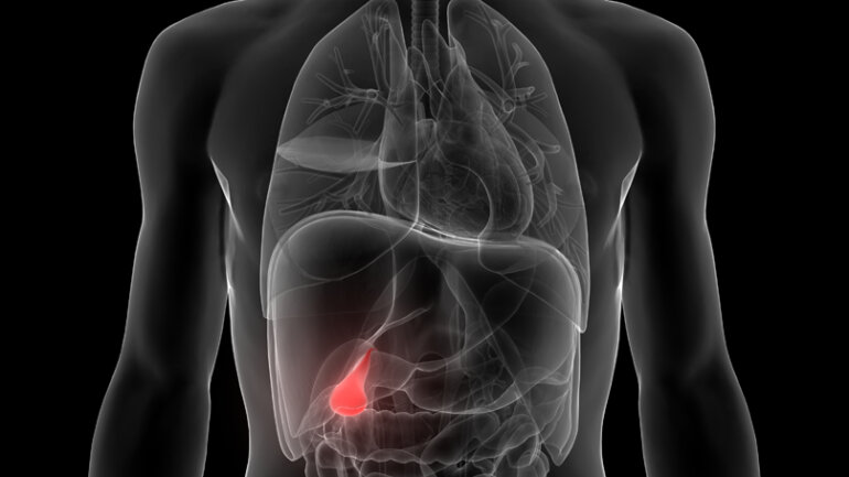 Ελάχιστα επεμβατική χειρουργική μέθοδος για οριστική λύση της χολολιθίασης