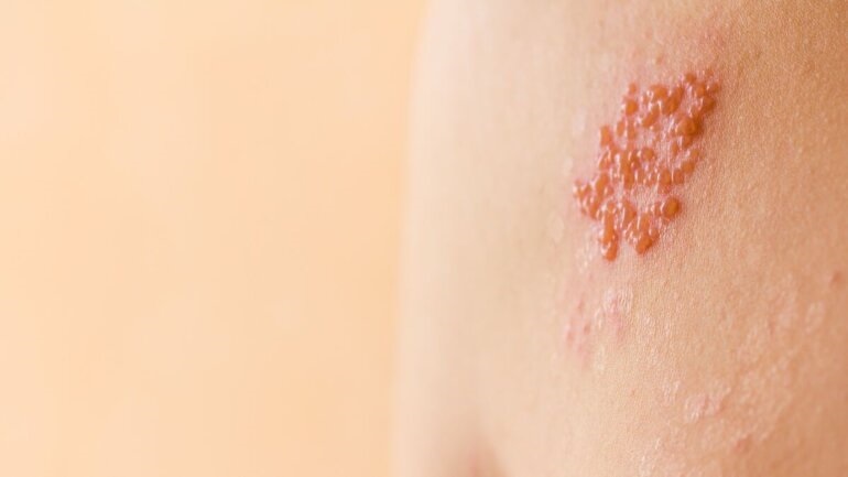 Η Pfizer σχεδιάζει εμβόλιο mRNA για τον έρπη ζωστήρα