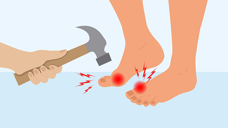 Ουρική αρθρίτιδα και σεξουαλική υγεία