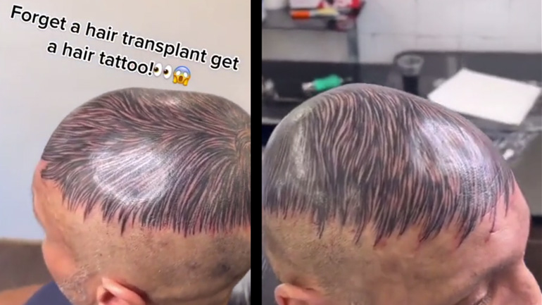 Φαλακρός έκανε τατουάζ μαλλιών στο κεφάλι του