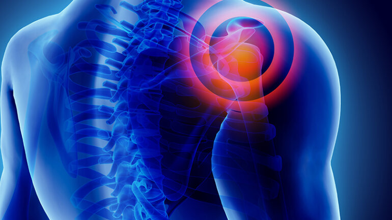 Ανάστροφη Ολική Αρθροπλαστική Ώμου