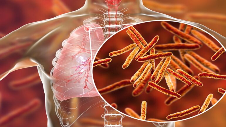 Η φυματίωση αποτελεί την 2η αιτία θανάτου από λοιμώδες αίτιο μετά τη λοίμωξη COVID-19 παγκοσμίως