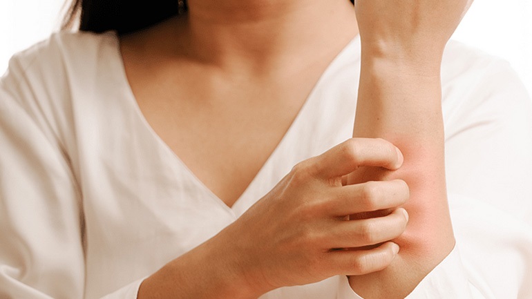 Τι πρέπει να ξέρετε για το έκζεμα