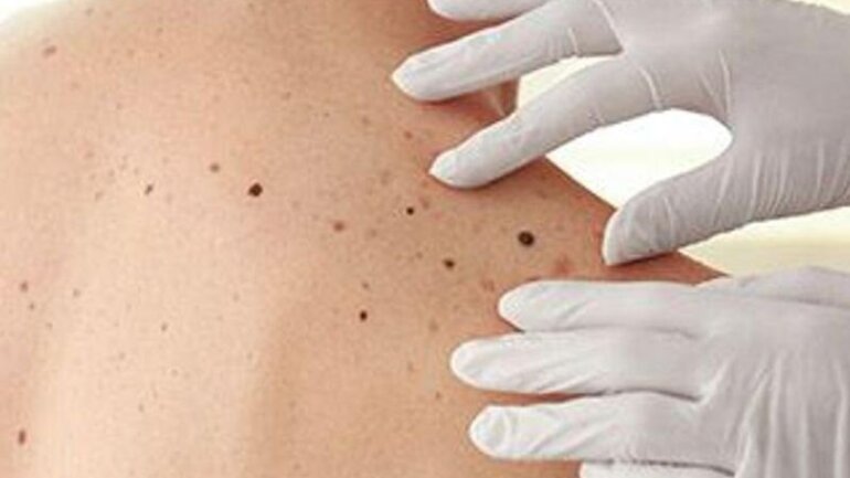 Ο κίνδυνος για καρκίνο του δέρματος είναι υψηλότερος για ενήλικες με ατοπική δερματίτιδα